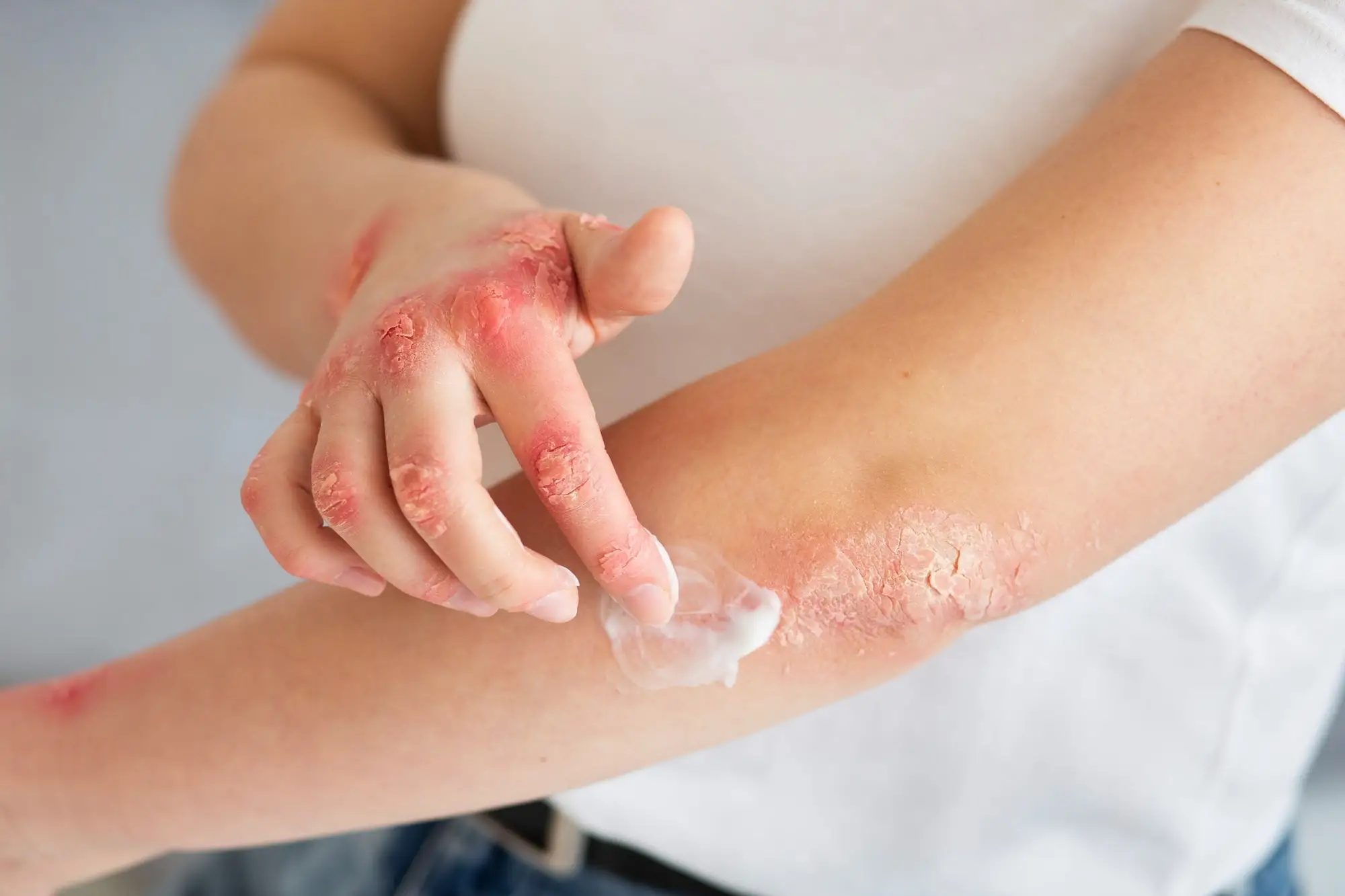 patient suffering from eczema dermatitis applying ointment
