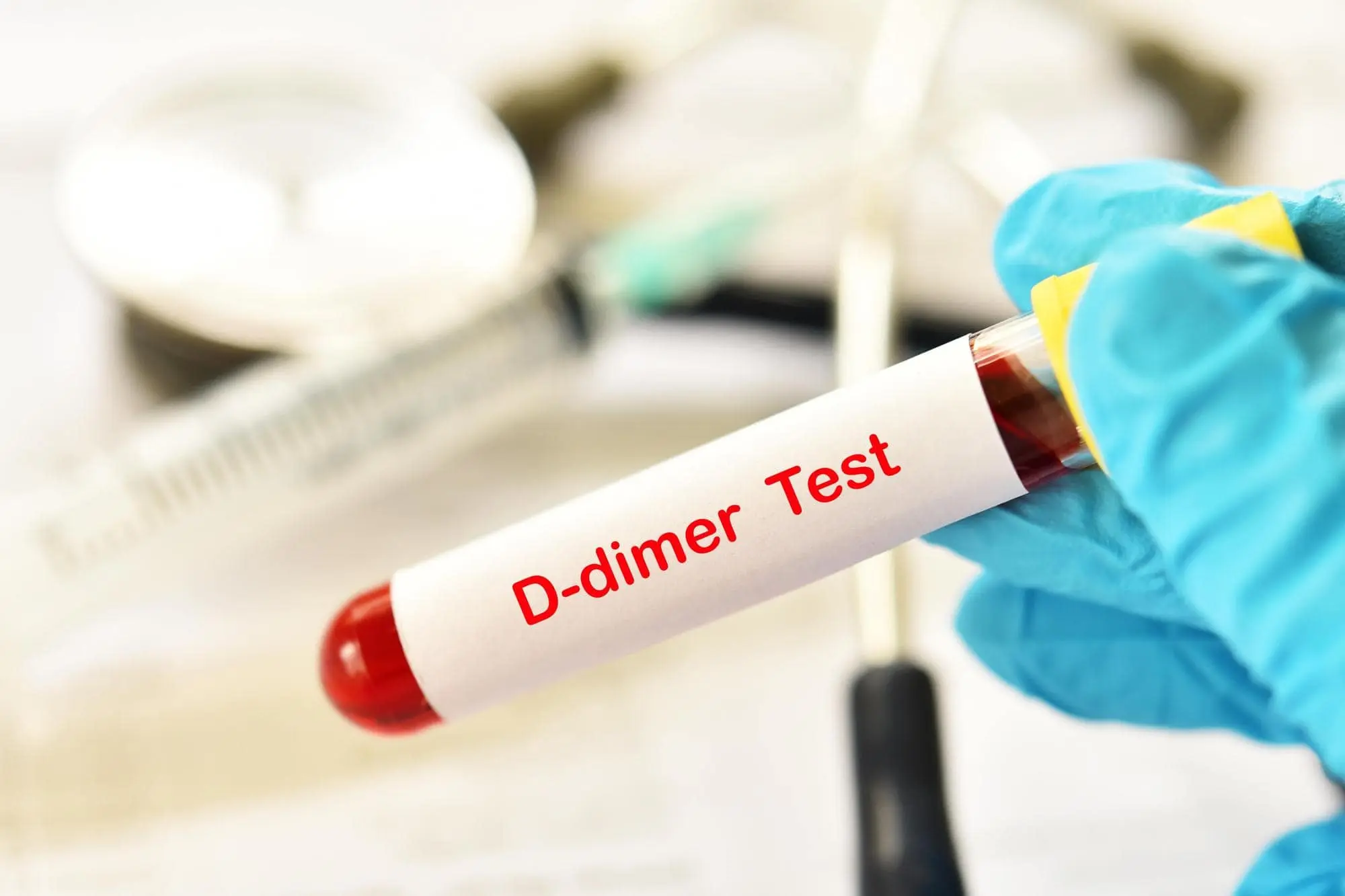 blood sample collected for d dimer test
