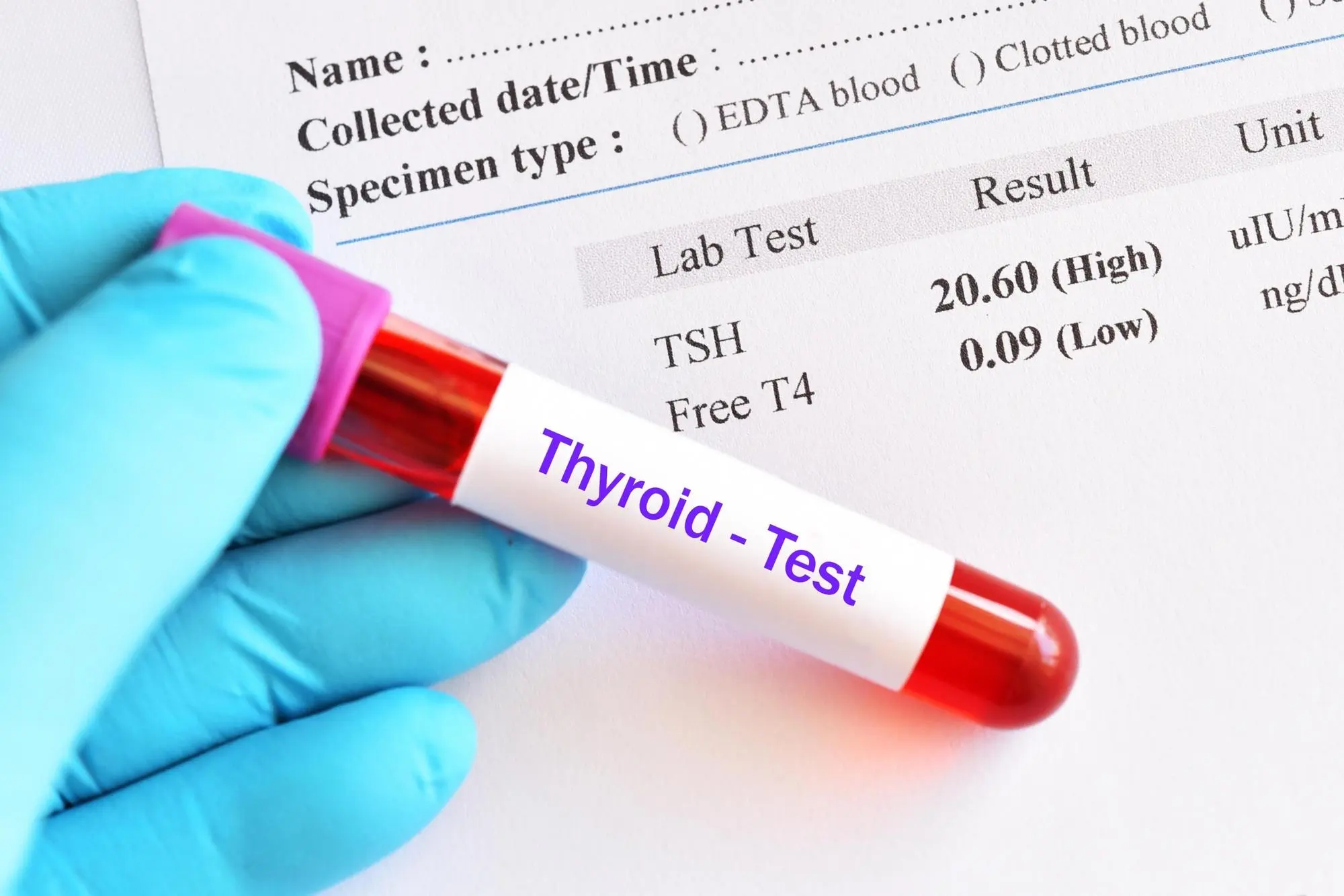 Understanding Thyroid Test Price